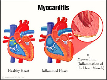 Myocarditis